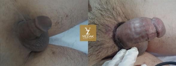 Before and After Glans Enlargement