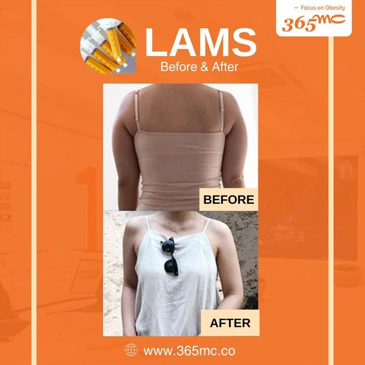 Entdecken Sie die eindrucksvollen Ergebnisse von LAMS in diesem Vorher-Nachher-Einblick. Entdecken Sie Ihr Selbstbewusstsein neu mit #365mctransformation