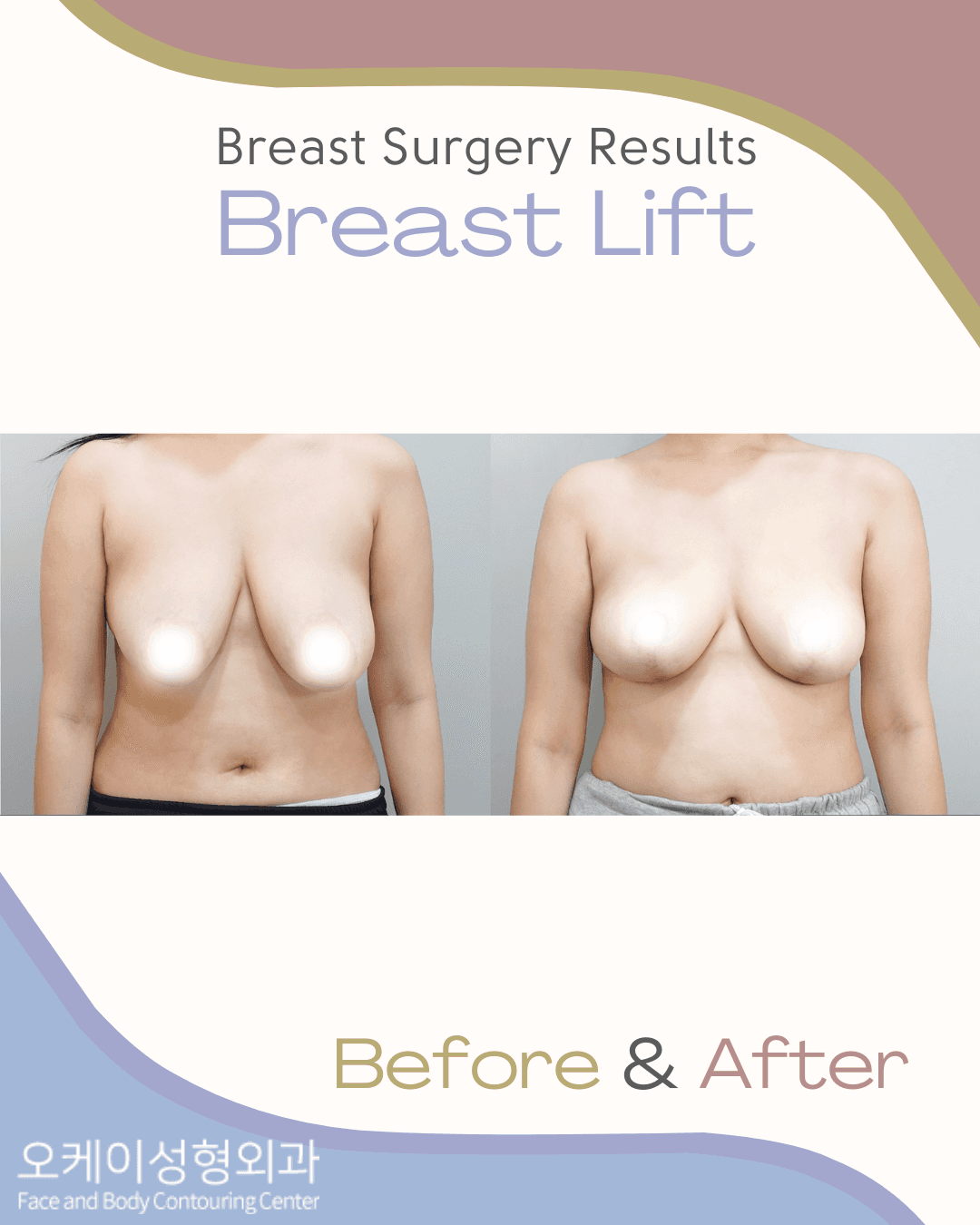 cost breast reduction korea
