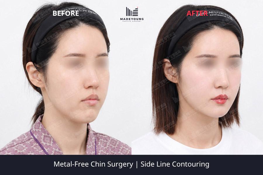 Free chin surgery side line contouring 2