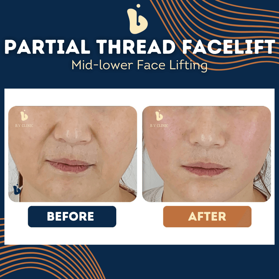 Filler für Lachfalten, Filler für Marionettenfalten, Fadenlifting im Gesicht, Fadenlifting
