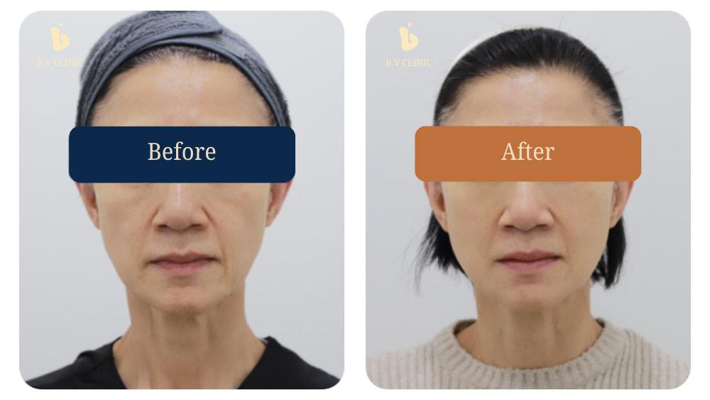 Before and After Thread Lift