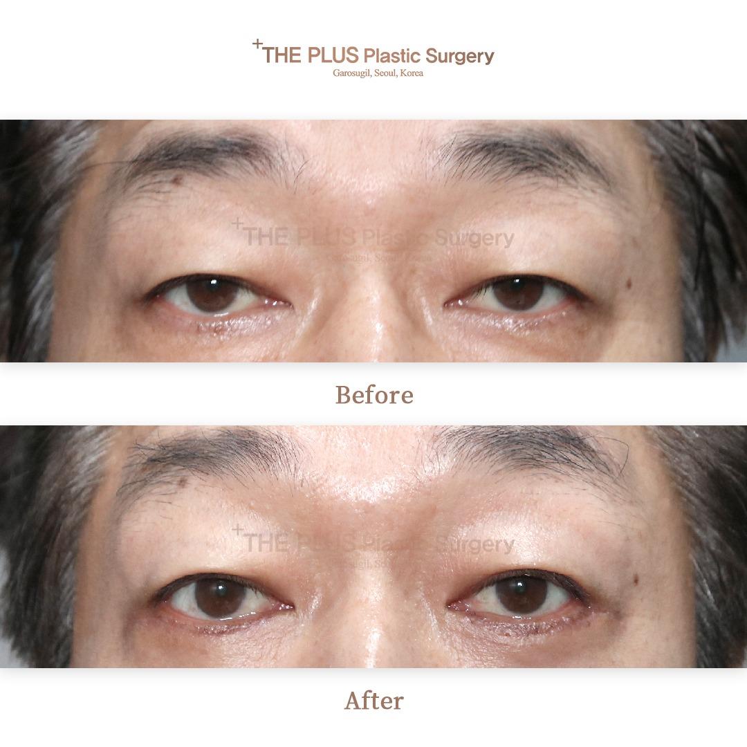 THEPLUS Plastic Surgery before and after image
