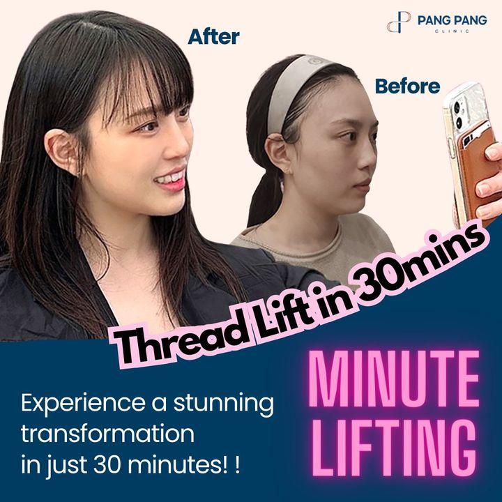 thread lift in korea