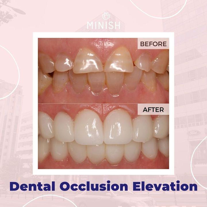 Verabschieden Sie sich von abgebrochenen Zähnen und freuen Sie sich auf Perfektion mit MINISH Veneers. Stellen Sie die natürliche Schönheit und Stärke Ihres Lächelns mit unserer fachkundigen Zahnbehandlung wieder her^^