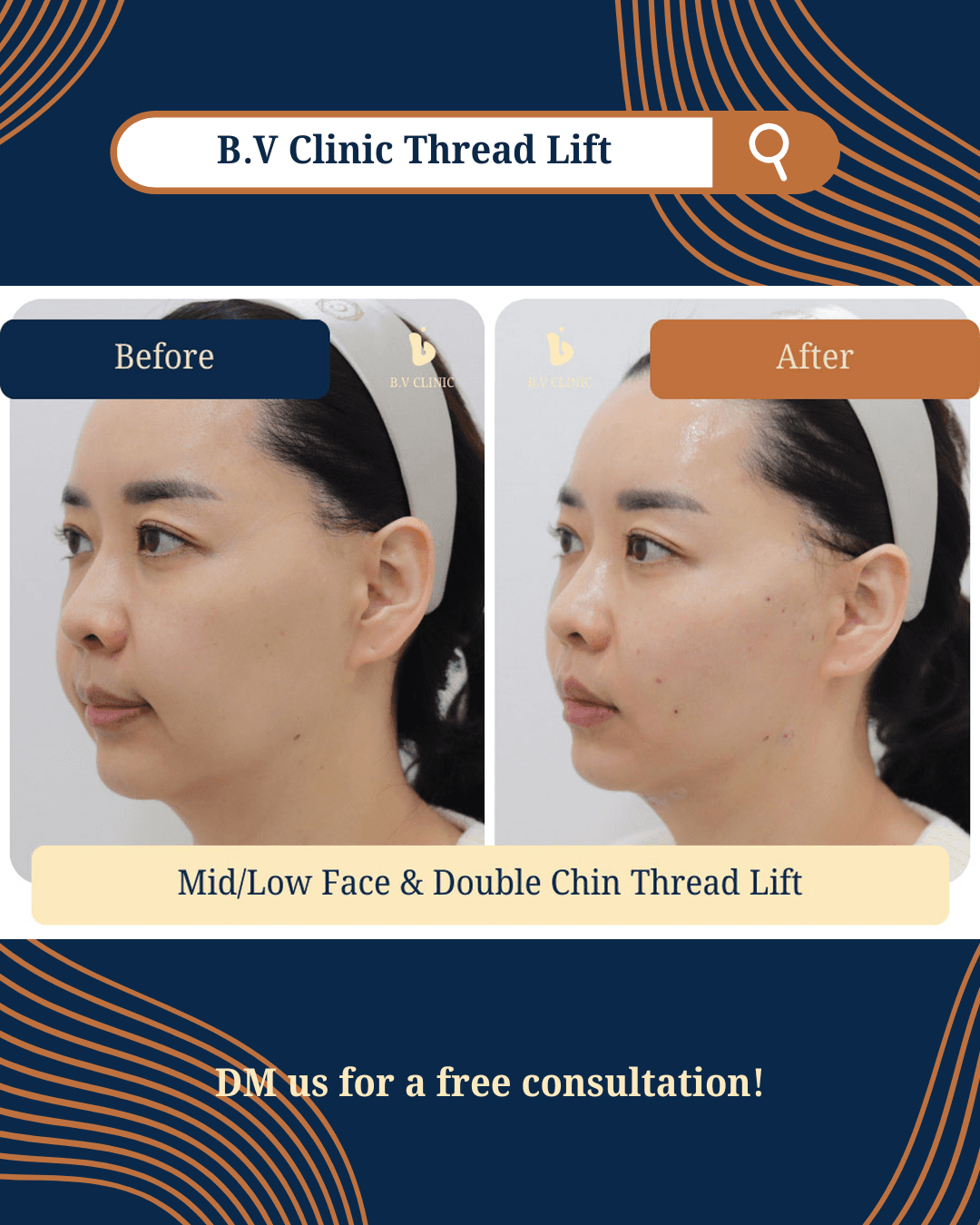 Face Thread Lift