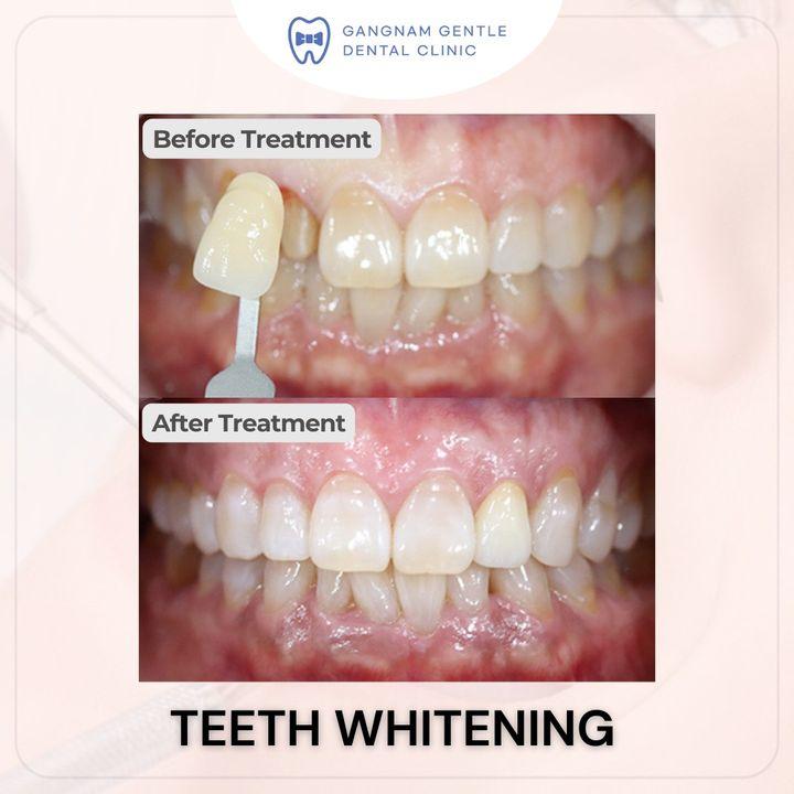 cost teeth whitening korea