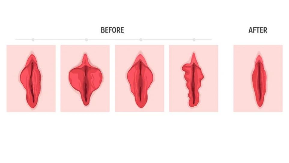Labiaplasty