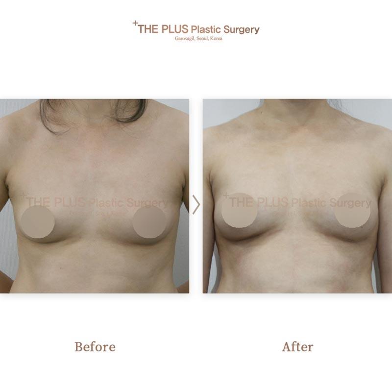 Breast augmentation with autologous fat grafting