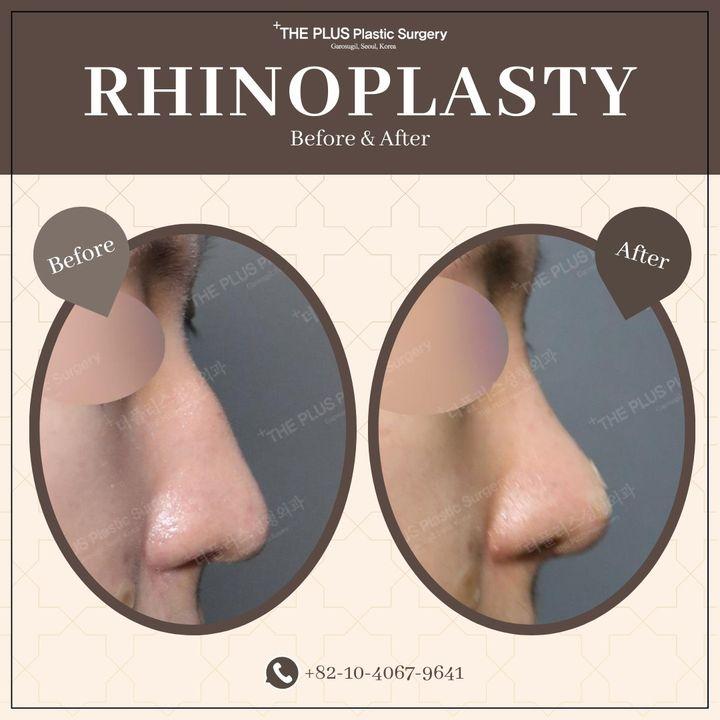 Stärken Sie Ihr Selbstvertrauen mit präziser Rhinoplastik bei ThePlus. Unsere Vorher-Nachher-Bilder zeigen die Kunst, natürliche Schönheit zu unterstreichen und dabei Ihren individuellen Charakter zu bewahren. Entdecken Sie ein harmonischeres Profil. #RhinoplastyExperts #naturalbeautyenhanced