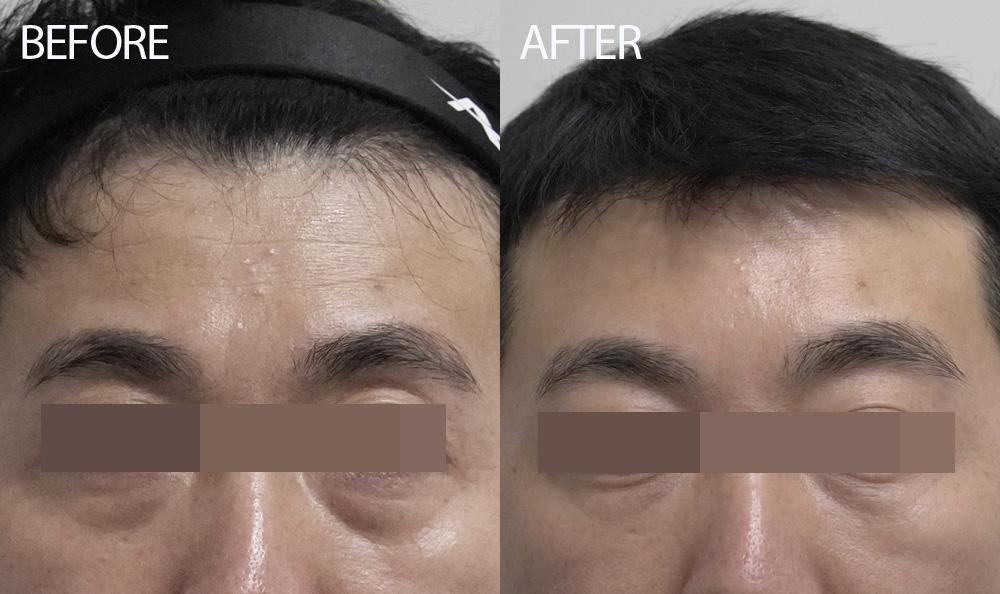 Before and After Stem Cell Facial