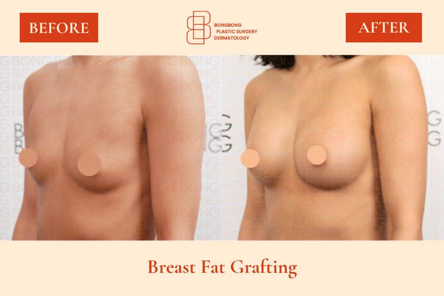 BongBong Plastic Surgery Dermatology before and after image