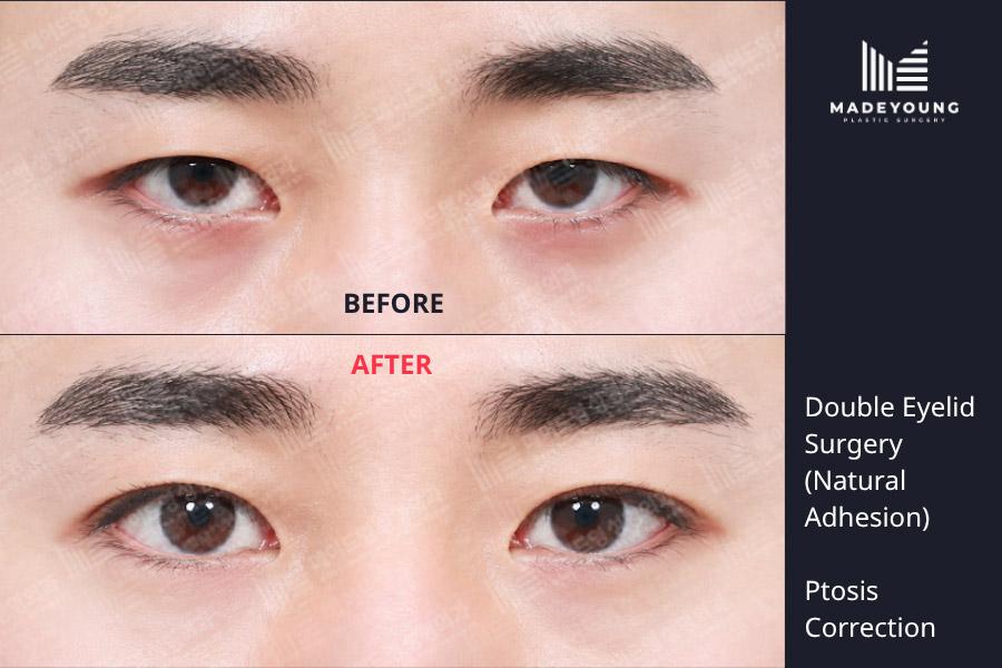Eyelid surgery natural adhesion ptosis correction