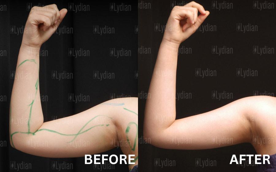 arm liposuction korea