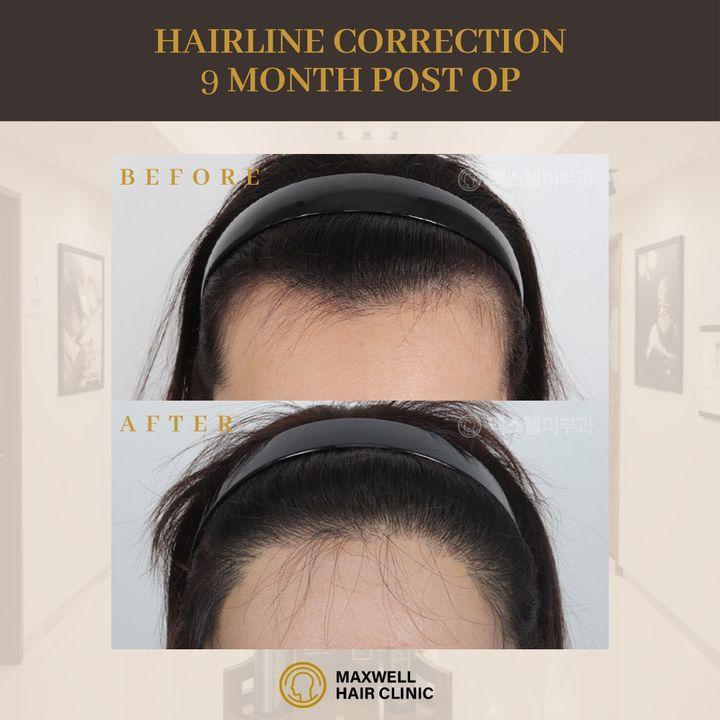 hairline lowering surgery korea