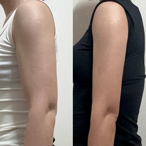 Before and After Fat Dissolving Injection