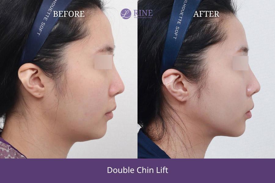 Double Chin lift