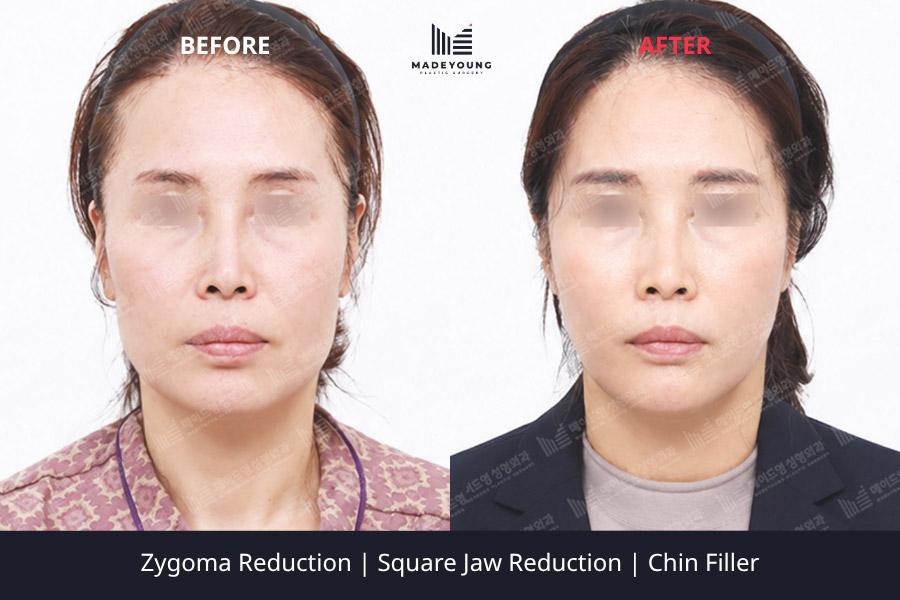 Reduction square jaw reduction chin filler 1