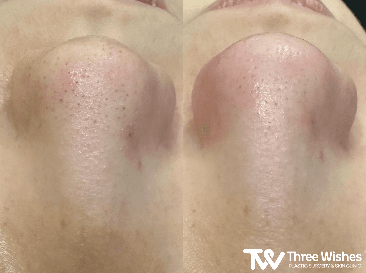tw-nose-pore-treatment3 