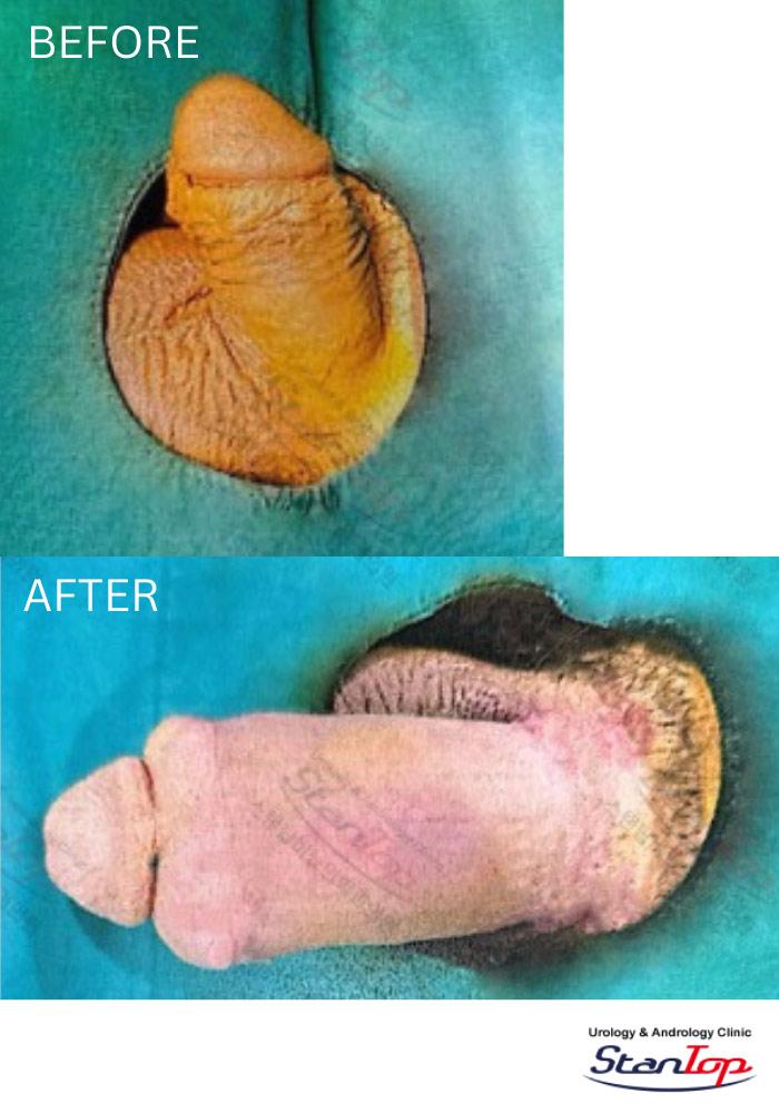 Stantop Penis Filler