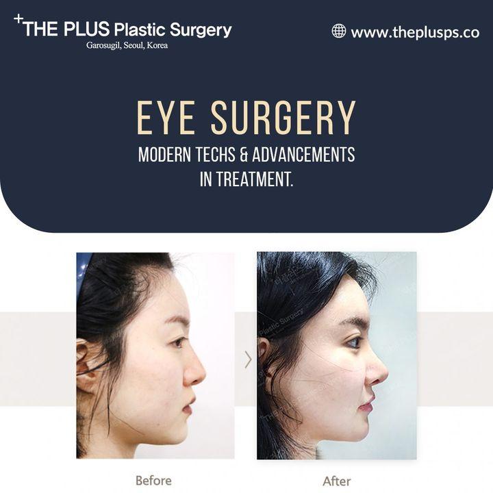 blepharoplasty korea