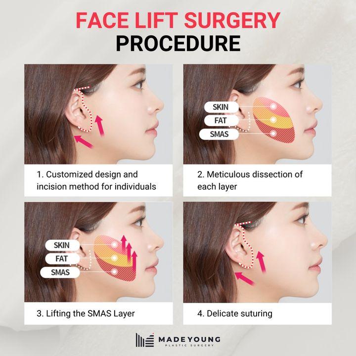 facelift in korea