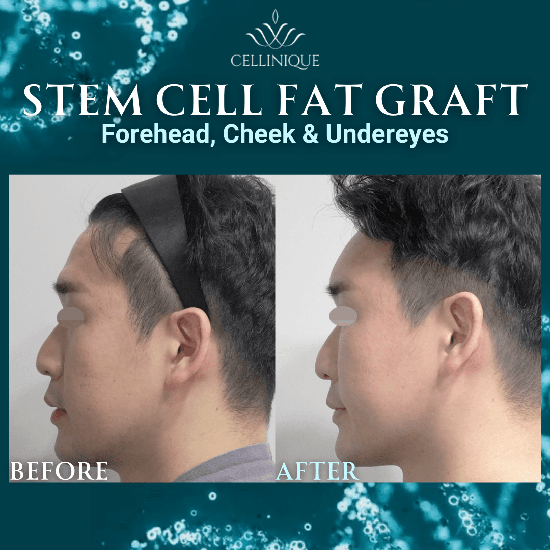Cellinique Clinic before and after image