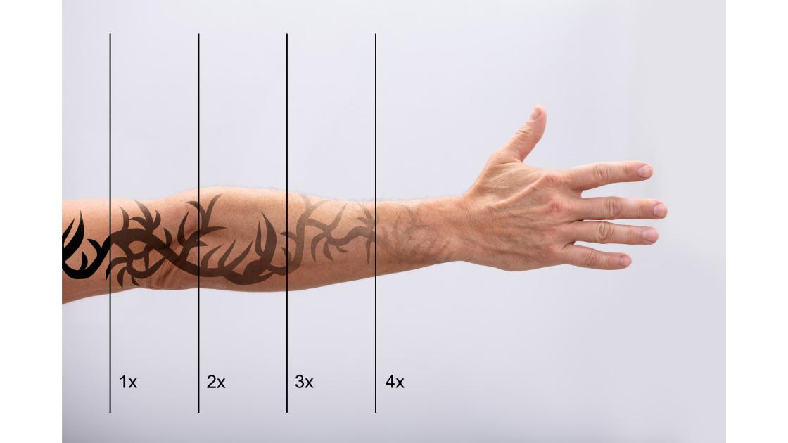 Laser Tattoo Removal