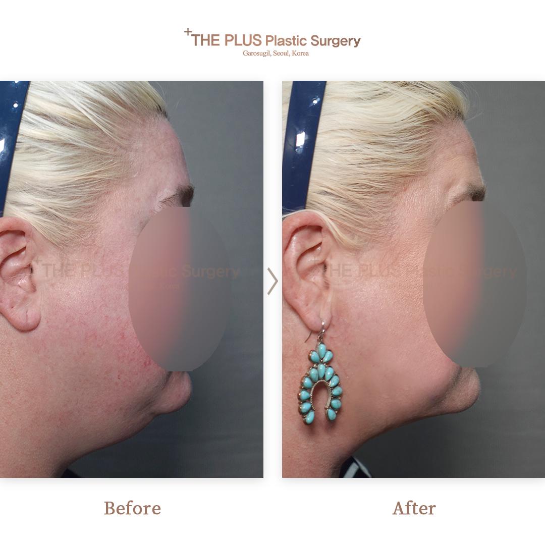 Thread Lifting & Double Chin Liposuction