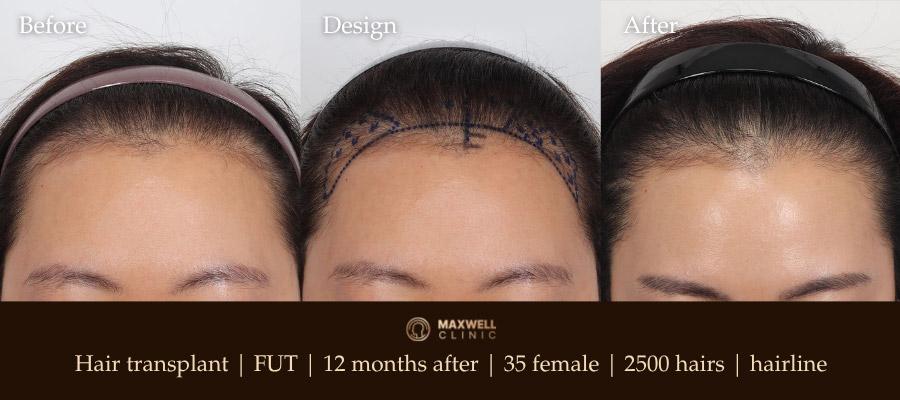 Female hairline
