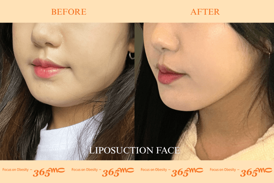 Liposuction - face