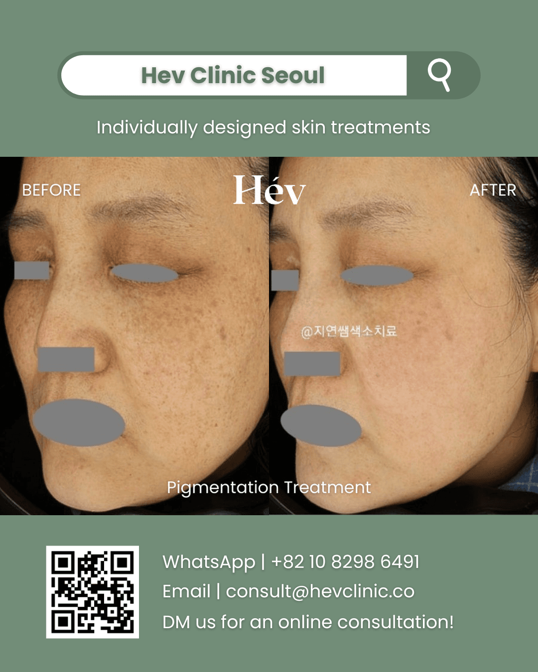 Pigmentation Treatment
