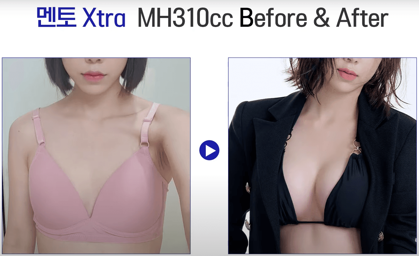 Mentor Breast Implant before after