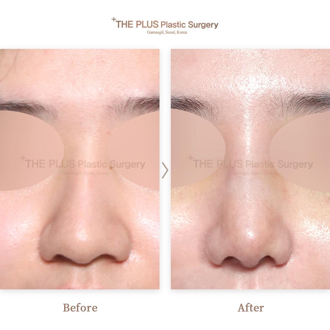 Rhinoplasty & Hump Correction & 3D Implant 