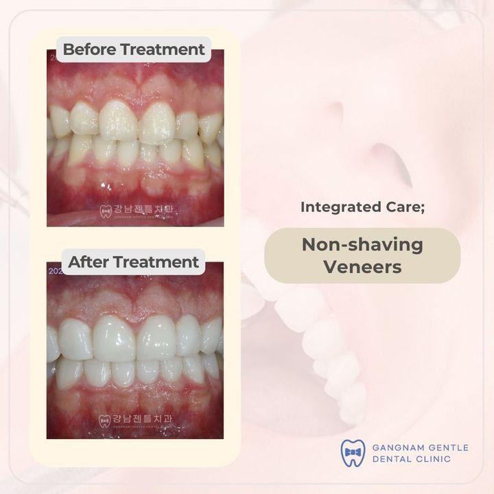 cost veneers korea