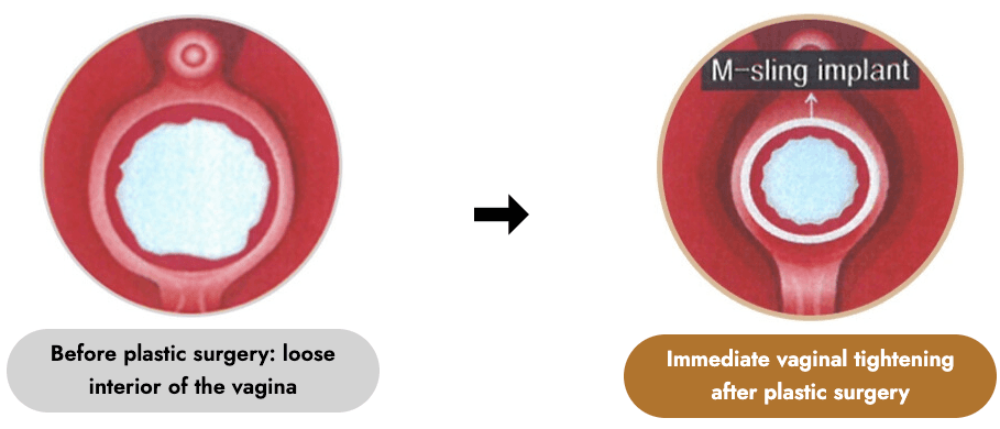 Vaginal Implant