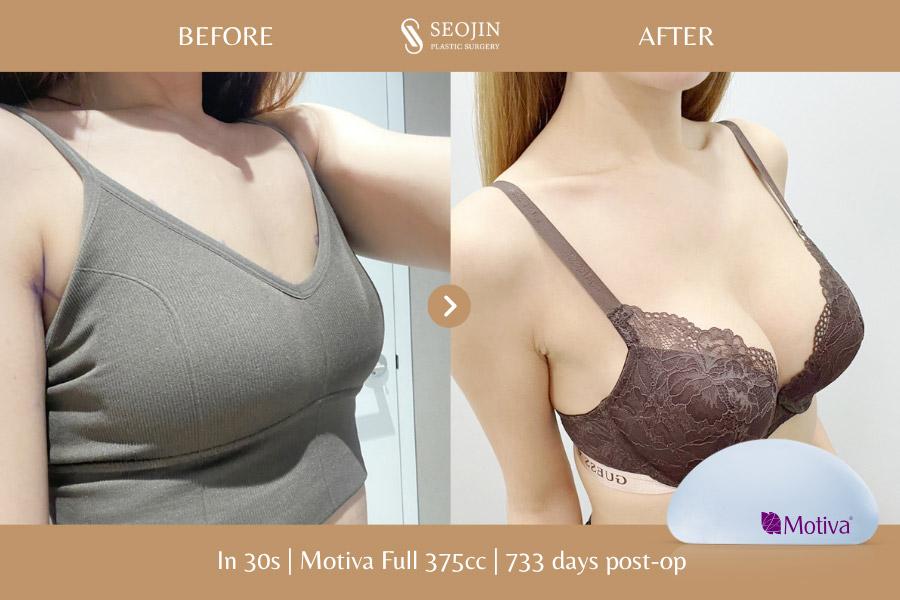 Seojin Plastic Surgery Clinic before and after image