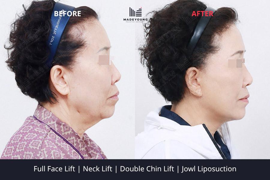 Face lift neck lift double chin lift jowl liposuction