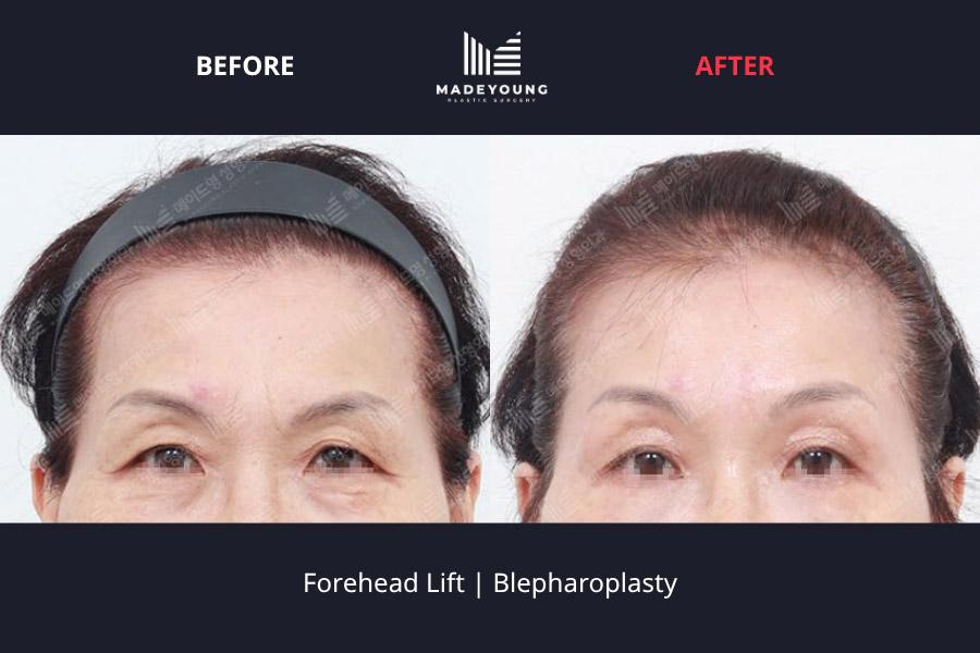 Made Young Plastic Surgery before and after image