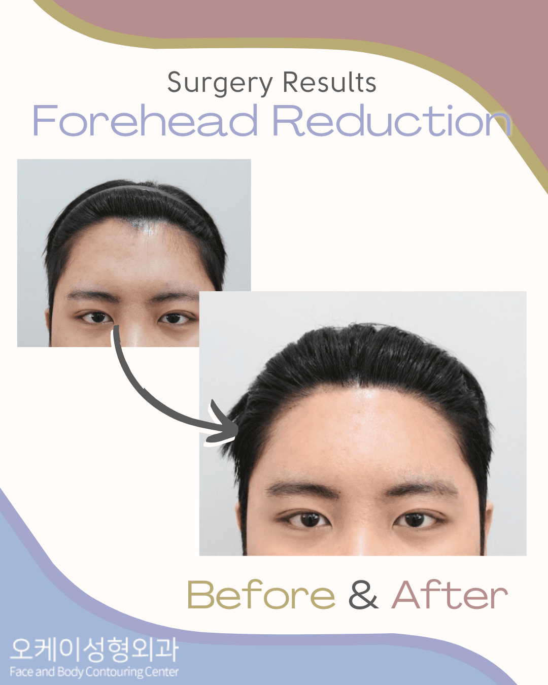 wide forehead korea