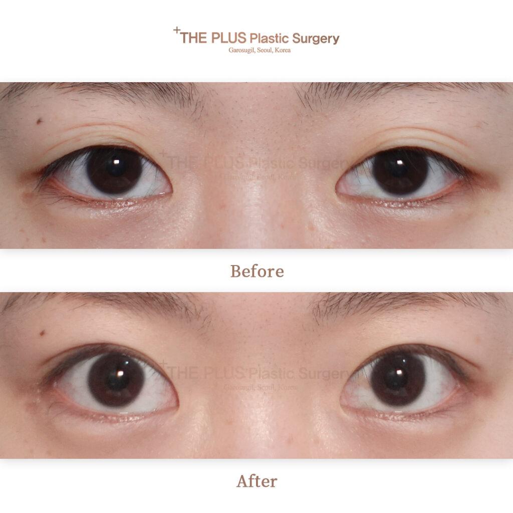 Revision Eye Surgery