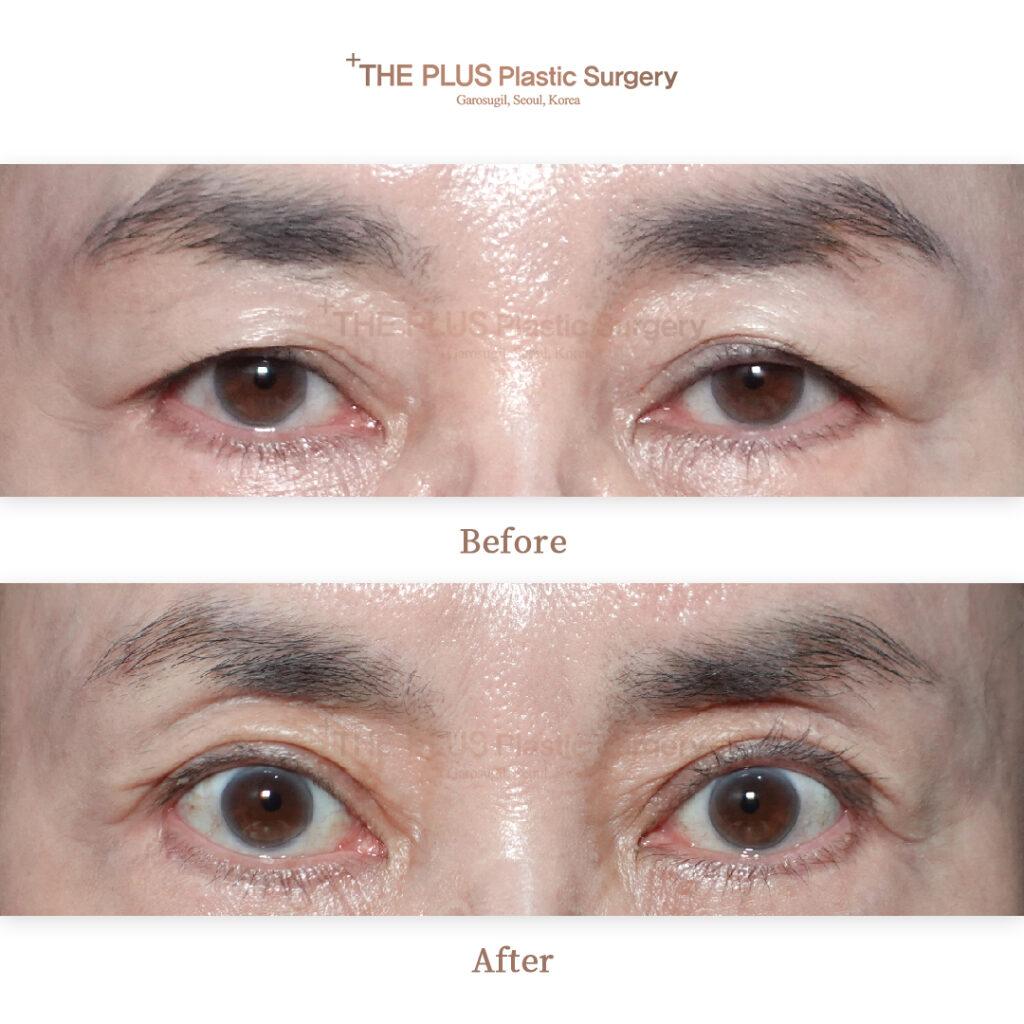 Upper Blepharoplasty
