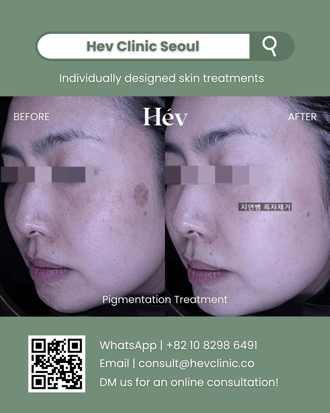 Pigmentation Treatment
