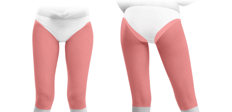 Thigh Liposuction, Knee Liposuction