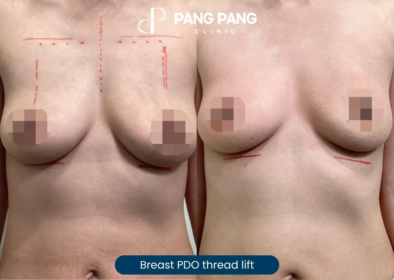 Female breast PDO thread lift