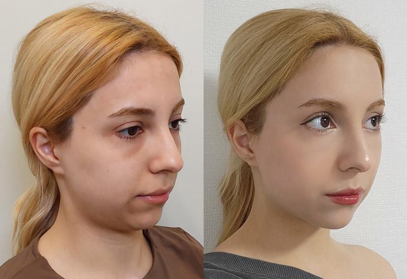Female double chin thread lift 1 week