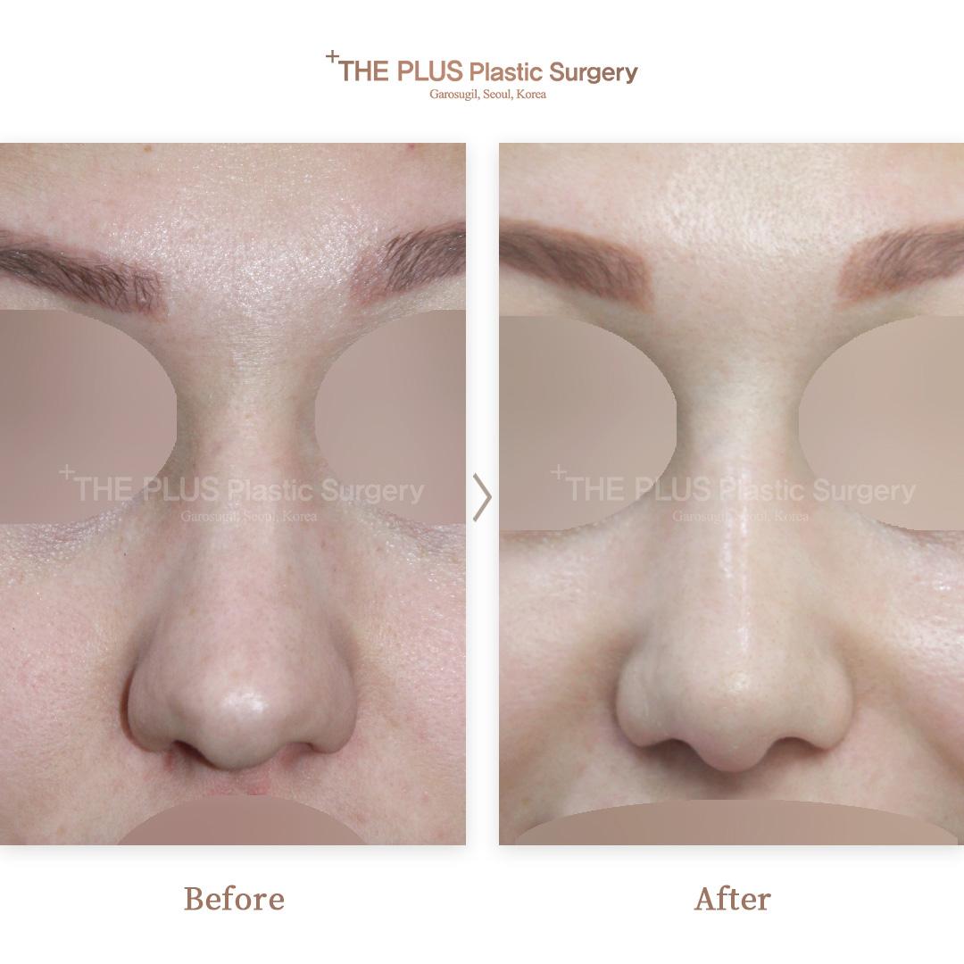 Primary Rhinoplasty & Nose Implant & Nose Osteotomy & Tip Plasty & Septoplasty & Rhinitis Surgery