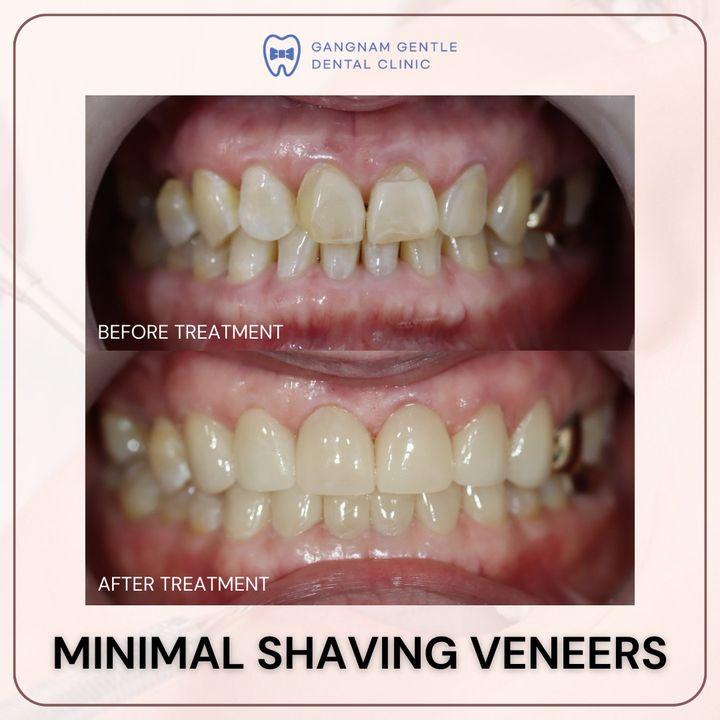 Transform your smile with our minimal shaving veneers. See the stunning before and after results and discover how gentle dental care can be.