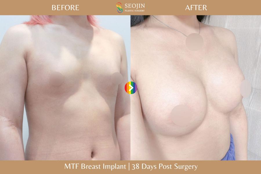Seojin Plastic Surgery Clinic before and after image