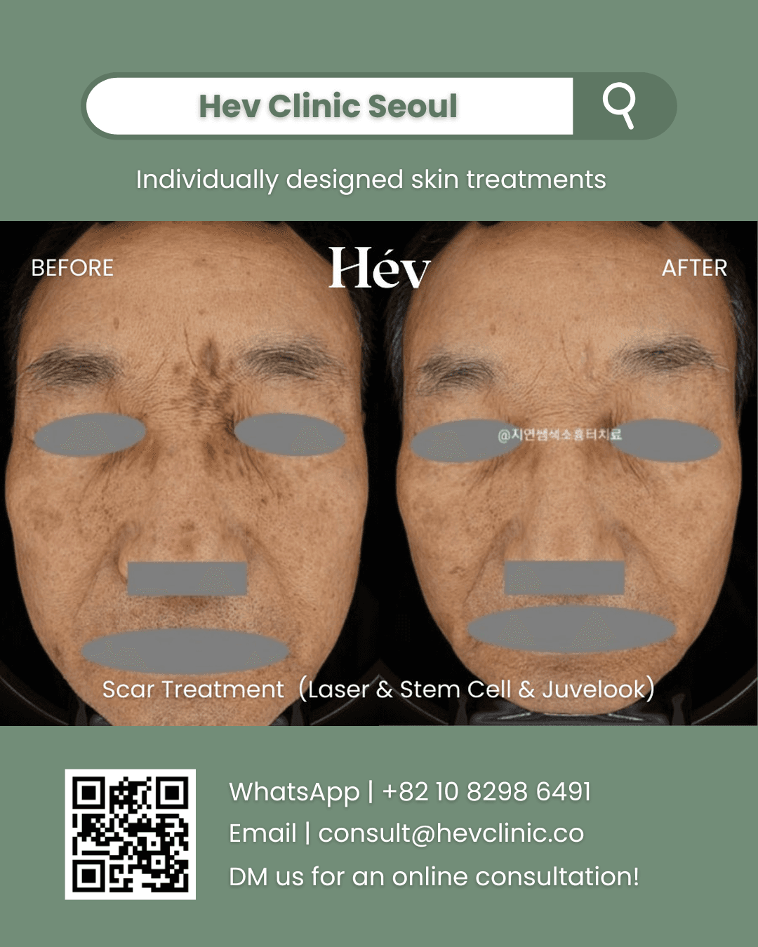 Scar Removal Laser, Stem Cell Facial